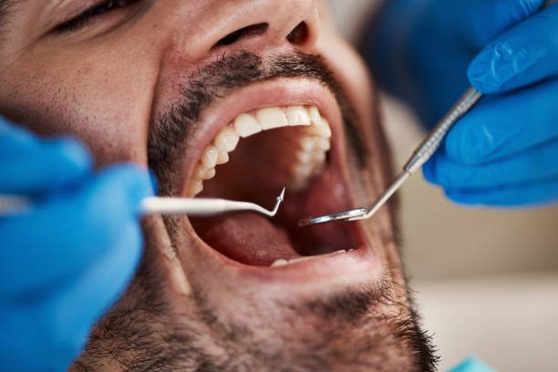 Best Emergency Dental Care for Broken or Chipped Teeth in Darlington, SC